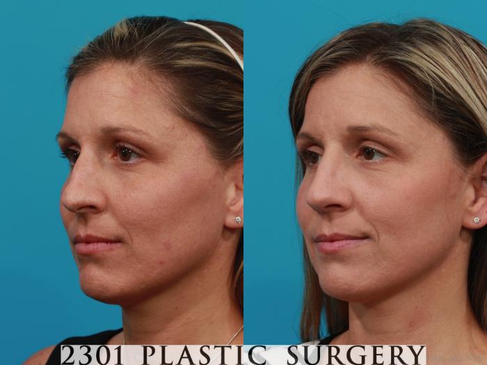 Before & After Rhinoplasty Case 280 View #3 View in Fort Worth, Plano, & Frisco, Texas
