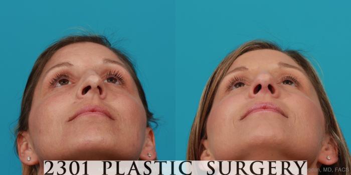 Before & After Rhinoplasty Case 280 View #4 View in Fort Worth, Plano, & Frisco, Texas