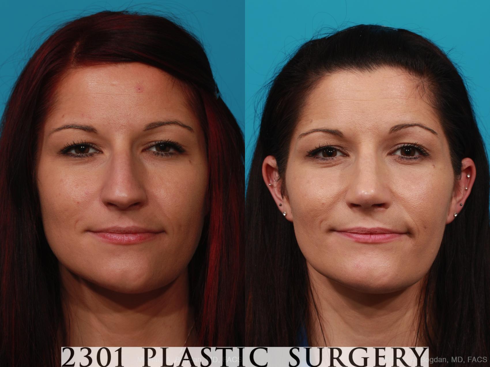 Before & After Rhinoplasty Case 293 View #1 View in Fort Worth, Plano, & Frisco, Texas
