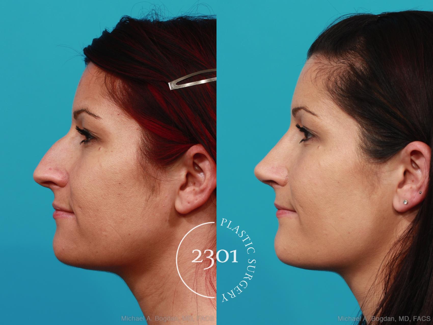 Before & After Rhinoplasty Case 293 View #2 View in Fort Worth, Plano, & Frisco, Texas