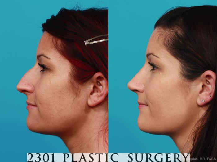 Before & After Rhinoplasty Case 293 View #2 View in Fort Worth, Plano, & Frisco, Texas