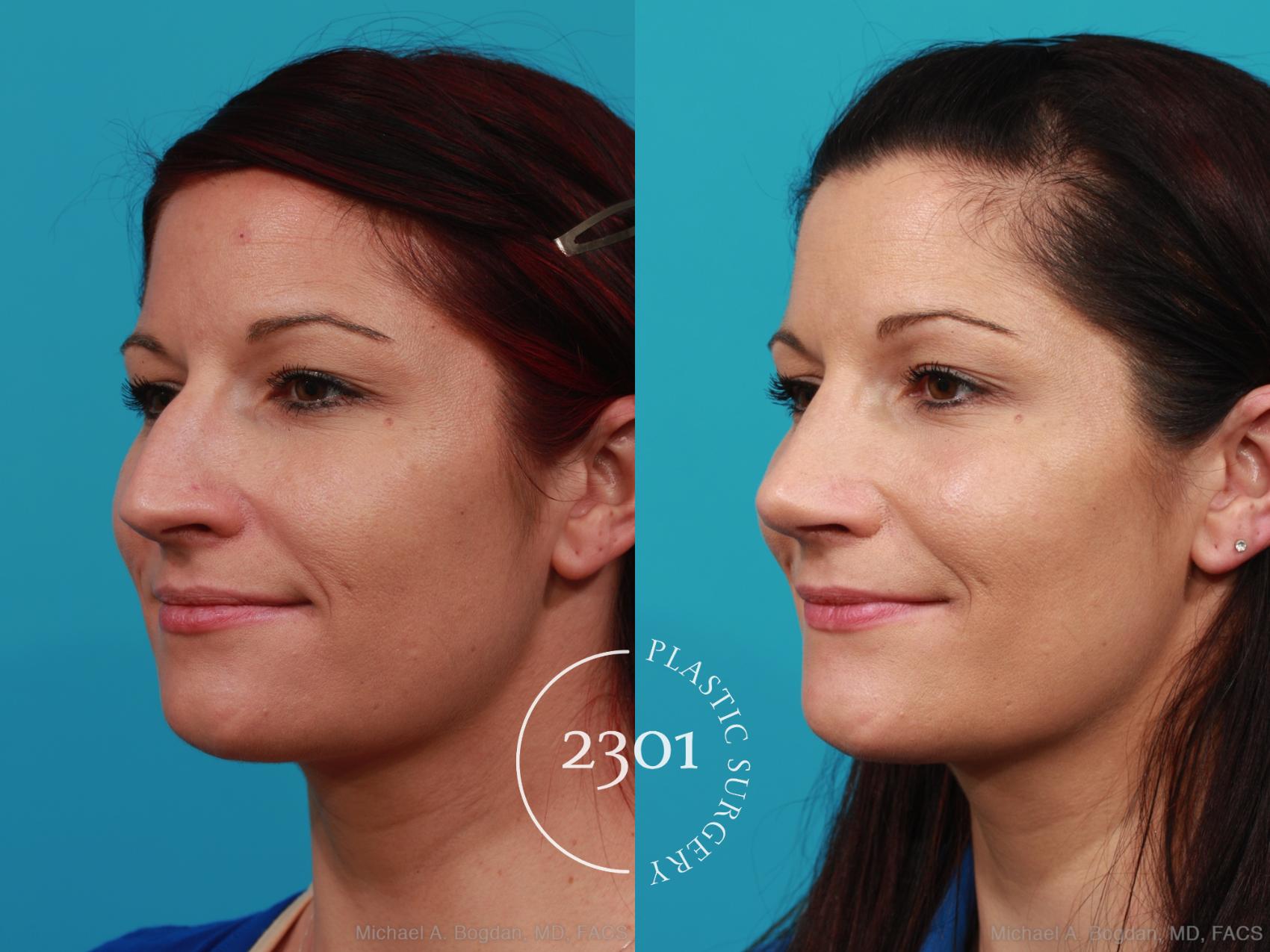 Before & After Rhinoplasty Case 293 View #3 View in Fort Worth, Plano, & Frisco, Texas
