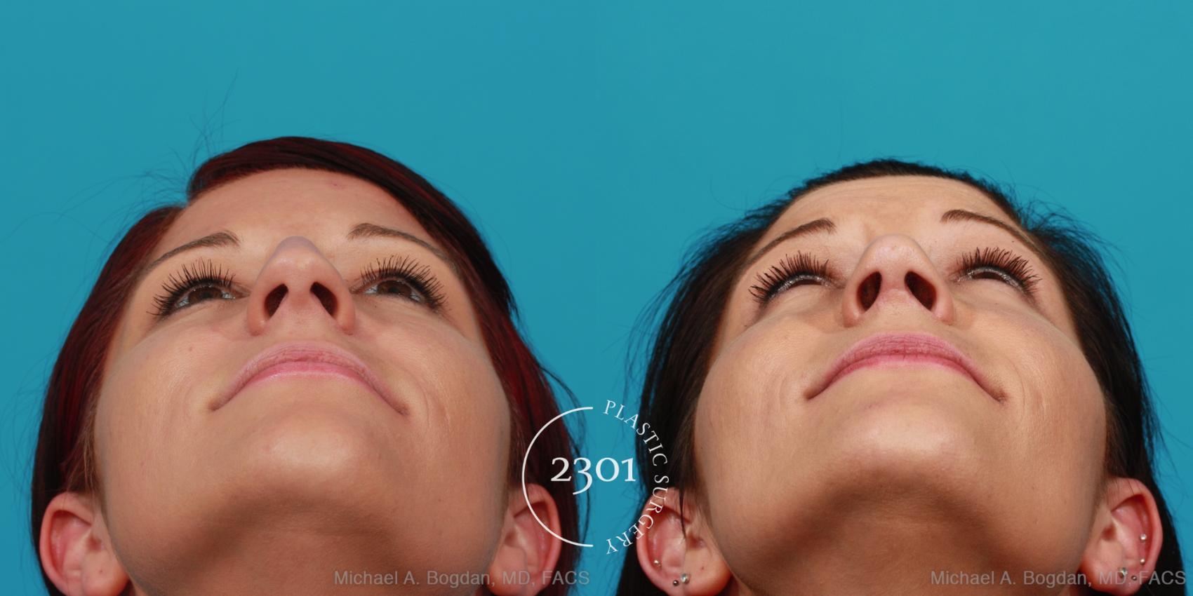 Before & After Rhinoplasty Case 293 View #4 View in Fort Worth, Plano, & Frisco, Texas