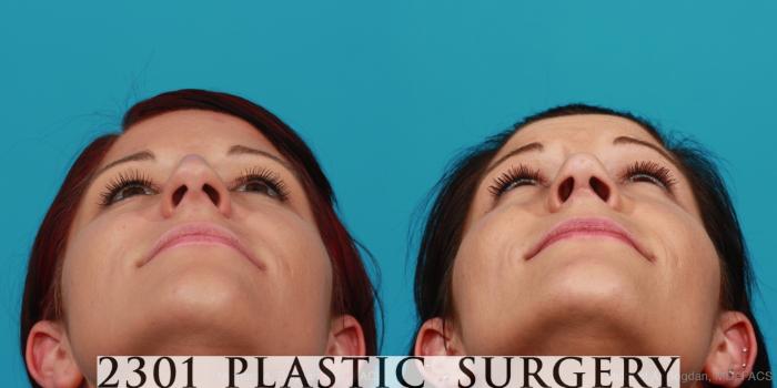 Before & After Rhinoplasty Case 293 View #4 View in Fort Worth, Plano, & Frisco, Texas