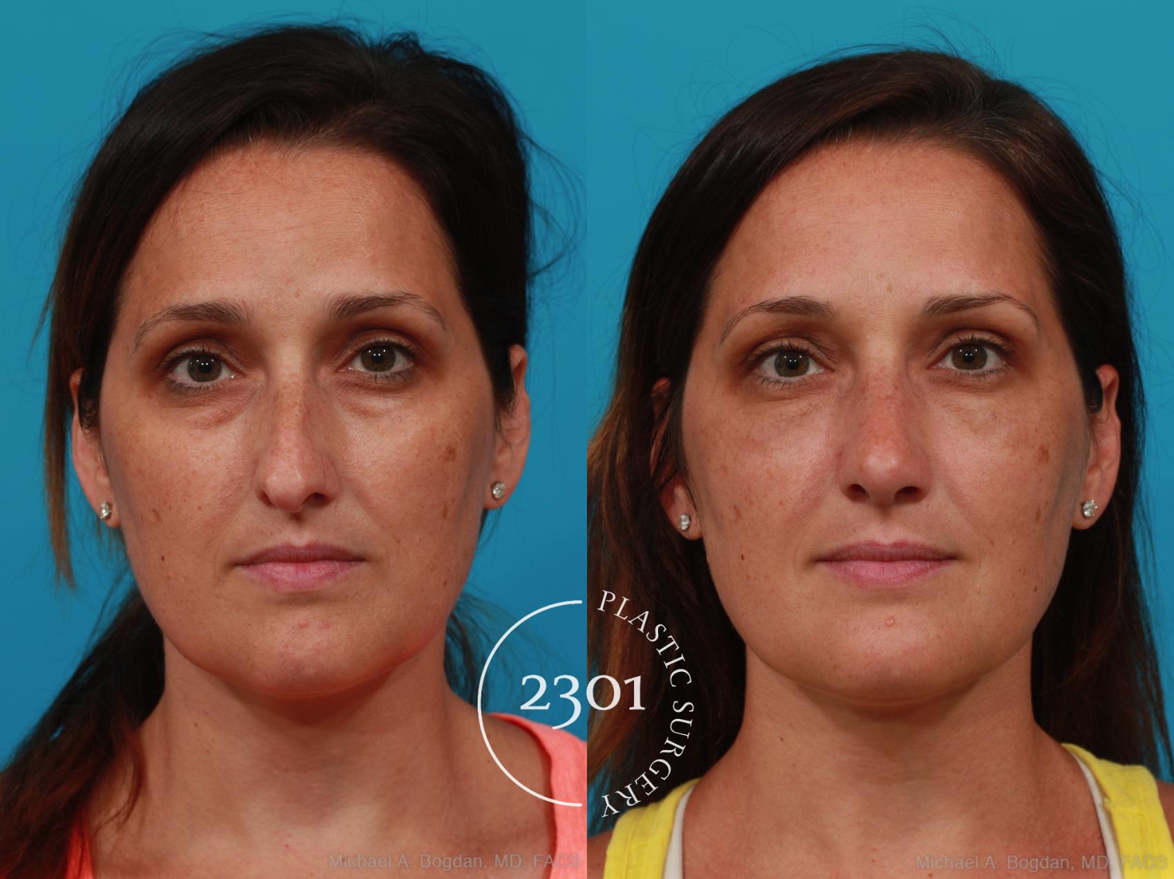 Before & After Rhinoplasty Case 304 View #1 View in Fort Worth, Plano, & Frisco, Texas