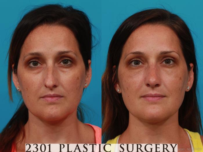 Before & After Rhinoplasty Case 304 View #1 View in Fort Worth, Plano, & Frisco, Texas