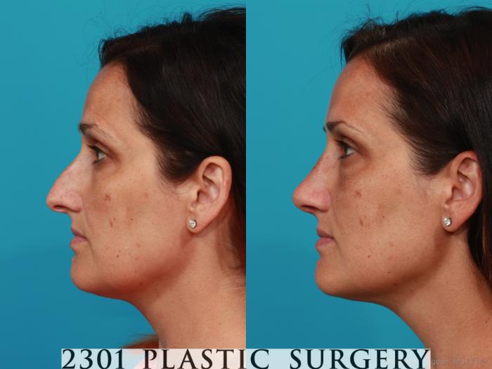 Before & After Rhinoplasty Case 304 View #2 View in Fort Worth, Plano, & Frisco, Texas