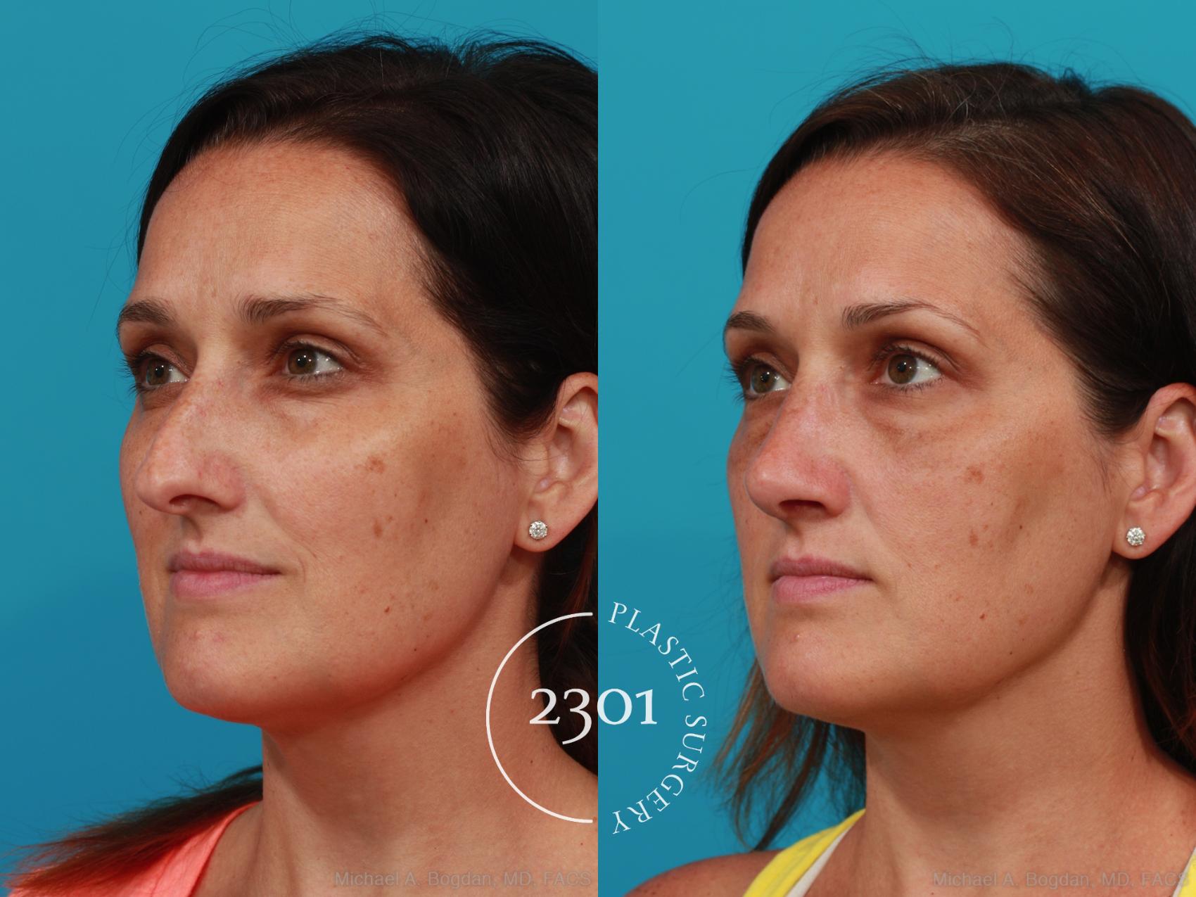 Before & After Rhinoplasty Case 304 View #3 View in Fort Worth, Plano, & Frisco, Texas