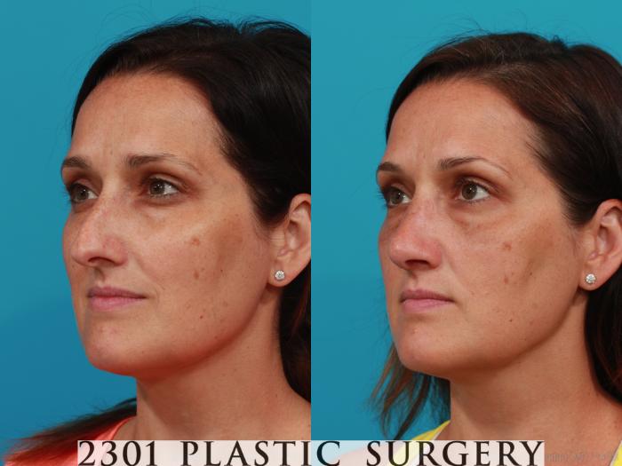 Before & After Rhinoplasty Case 304 View #3 View in Fort Worth, Plano, & Frisco, Texas