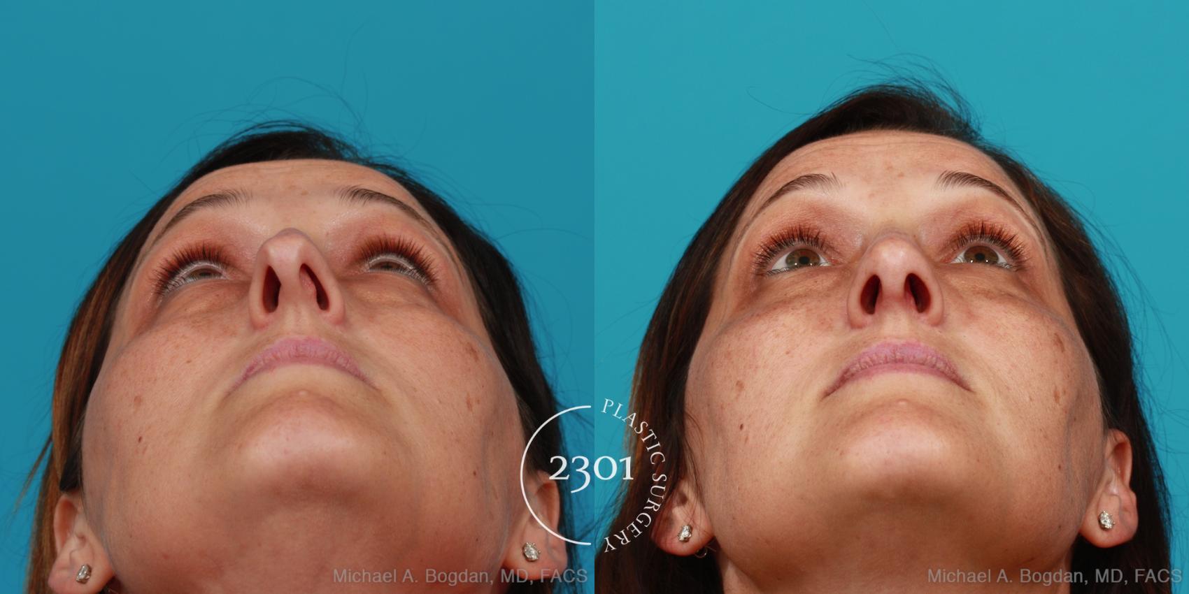 Before & After Rhinoplasty Case 304 View #4 View in Fort Worth, Plano, & Frisco, Texas