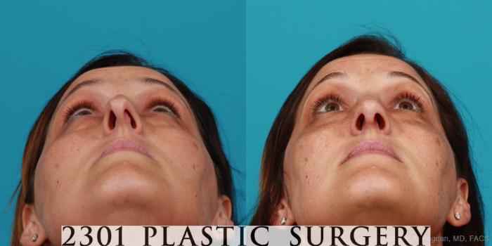 Before & After Rhinoplasty Case 304 View #4 View in Fort Worth, Plano, & Frisco, Texas