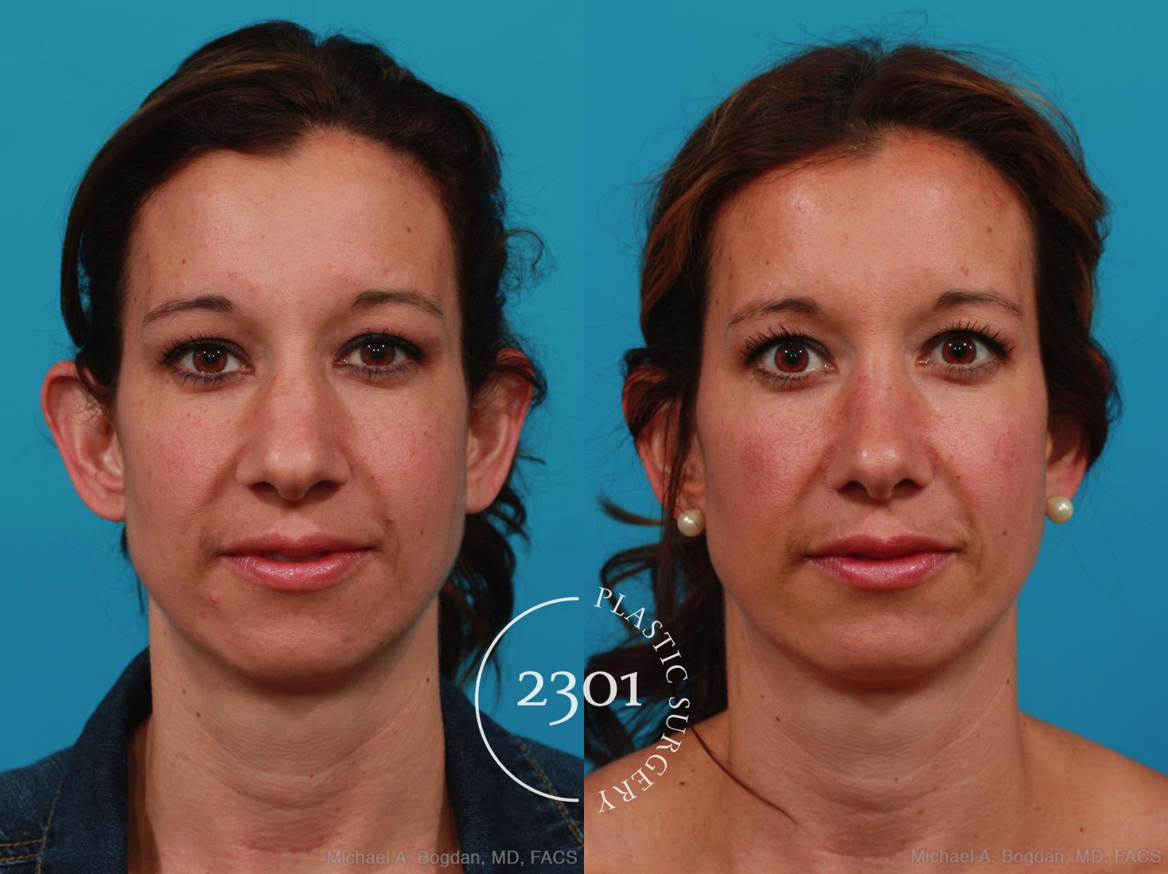 Before & After Rhinoplasty Case 338 View #1 View in Fort Worth, Plano, & Frisco, Texas