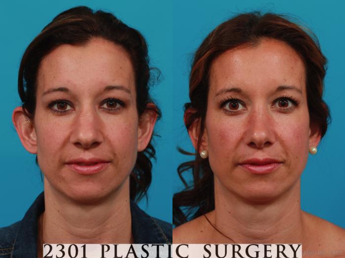 Before & After Rhinoplasty Case 338 View #1 View in Fort Worth, Plano, & Frisco, Texas