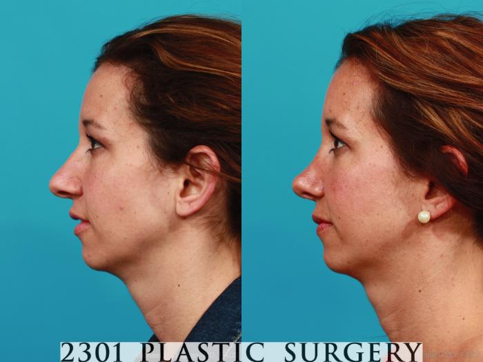 Before & After Rhinoplasty Case 338 View #2 View in Fort Worth, Plano, & Frisco, Texas