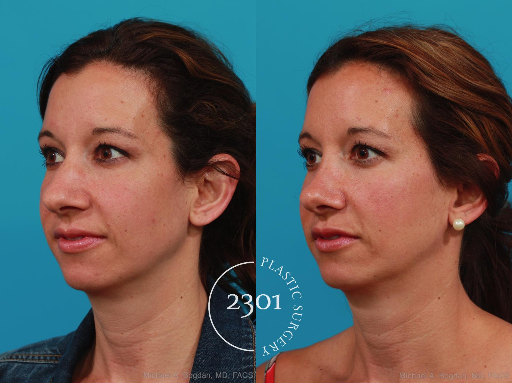 Before & After Rhinoplasty Case 338 View #3 View in Fort Worth, Plano, & Frisco, Texas