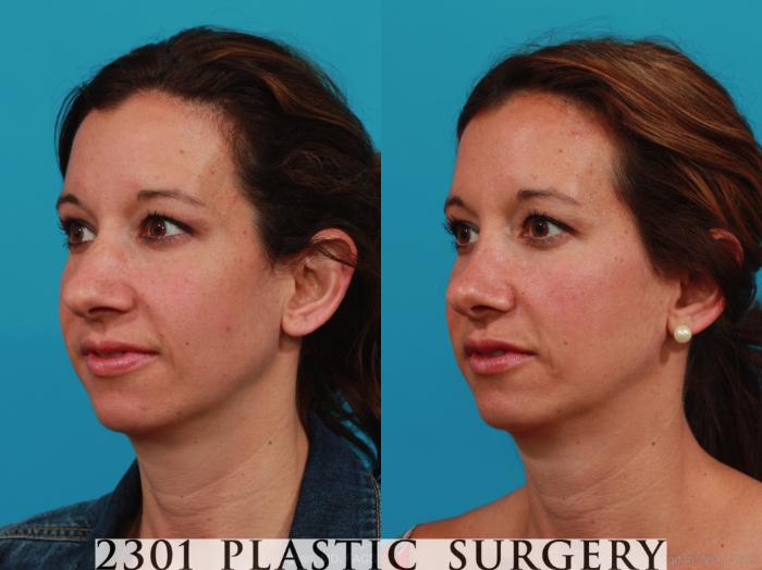 Before & After Rhinoplasty Case 338 View #3 View in Fort Worth, Plano, & Frisco, Texas