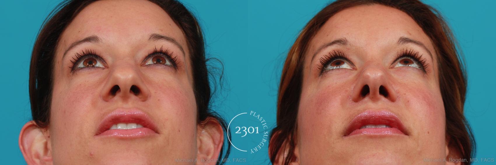 Before & After Rhinoplasty Case 338 View #4 View in Fort Worth, Plano, & Frisco, Texas