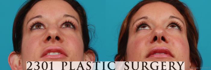 Before & After Rhinoplasty Case 338 View #4 View in Fort Worth, Plano, & Frisco, Texas
