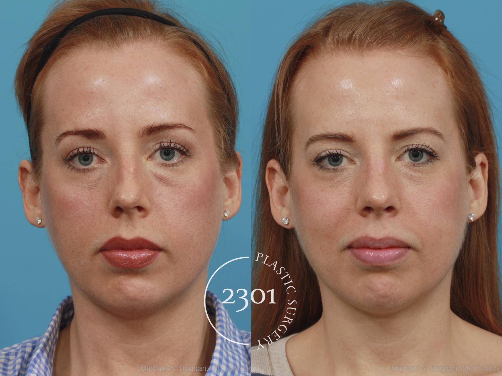 Before & After Rhinoplasty Case 380 View #1 View in Fort Worth, Plano, & Frisco, Texas