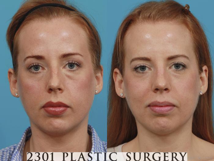 Before & After Rhinoplasty Case 380 View #1 View in Fort Worth, Plano, & Frisco, Texas