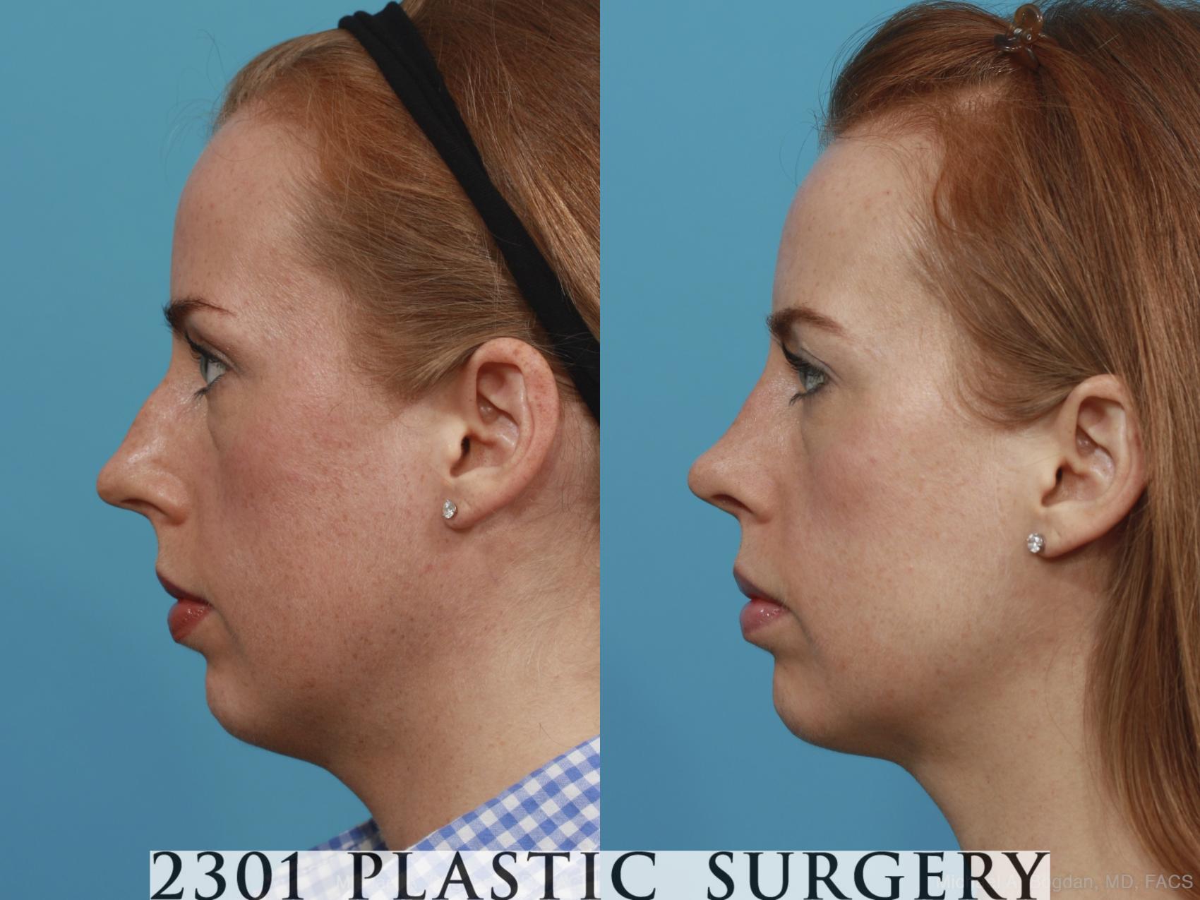 Before & After Rhinoplasty Case 380 View #2 View in Fort Worth & Frisco, Texas