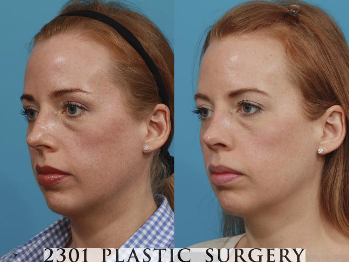 Before & After Rhinoplasty Case 380 View #3 View in Fort Worth, Plano, & Frisco, Texas