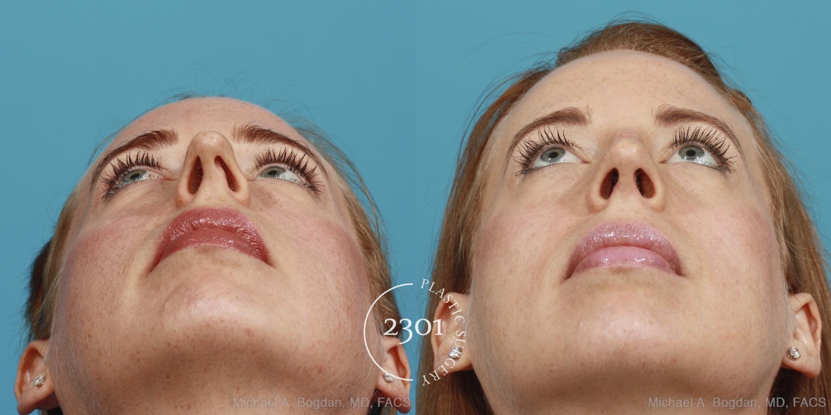 Before & After Rhinoplasty Case 380 View #4 View in Fort Worth, Plano, & Frisco, Texas