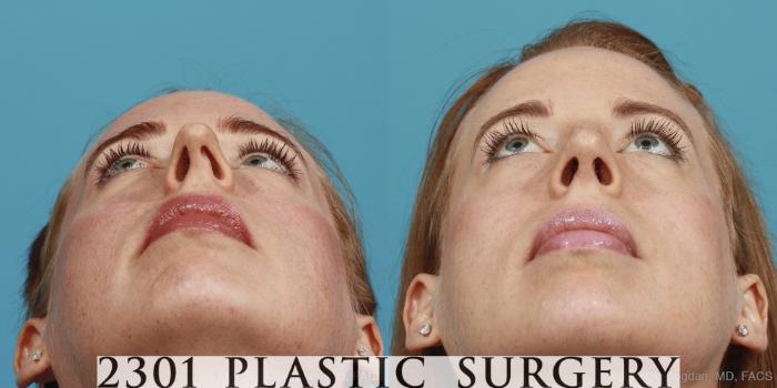 Before & After Rhinoplasty Case 380 View #4 View in Fort Worth, Plano, & Frisco, Texas