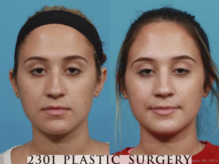 Before & After Rhinoplasty Case 400 View #1 View in Fort Worth, Plano, & Frisco, Texas