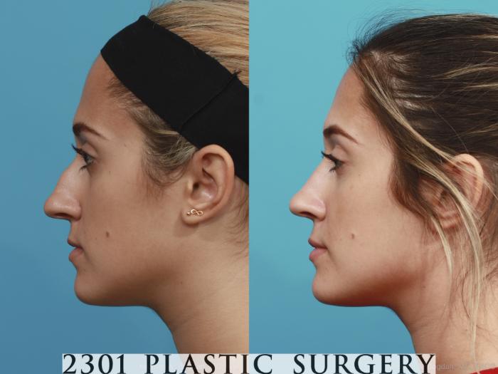 Before & After Rhinoplasty Case 400 View #2 View in Fort Worth, Plano, & Frisco, Texas