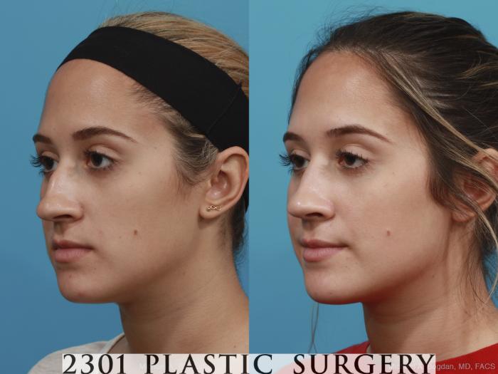 Before & After Rhinoplasty Case 400 View #3 View in Fort Worth, Plano, & Frisco, Texas
