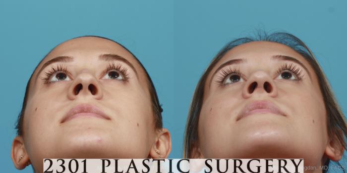 Before & After Rhinoplasty Case 400 View #4 View in Fort Worth, Plano, & Frisco, Texas