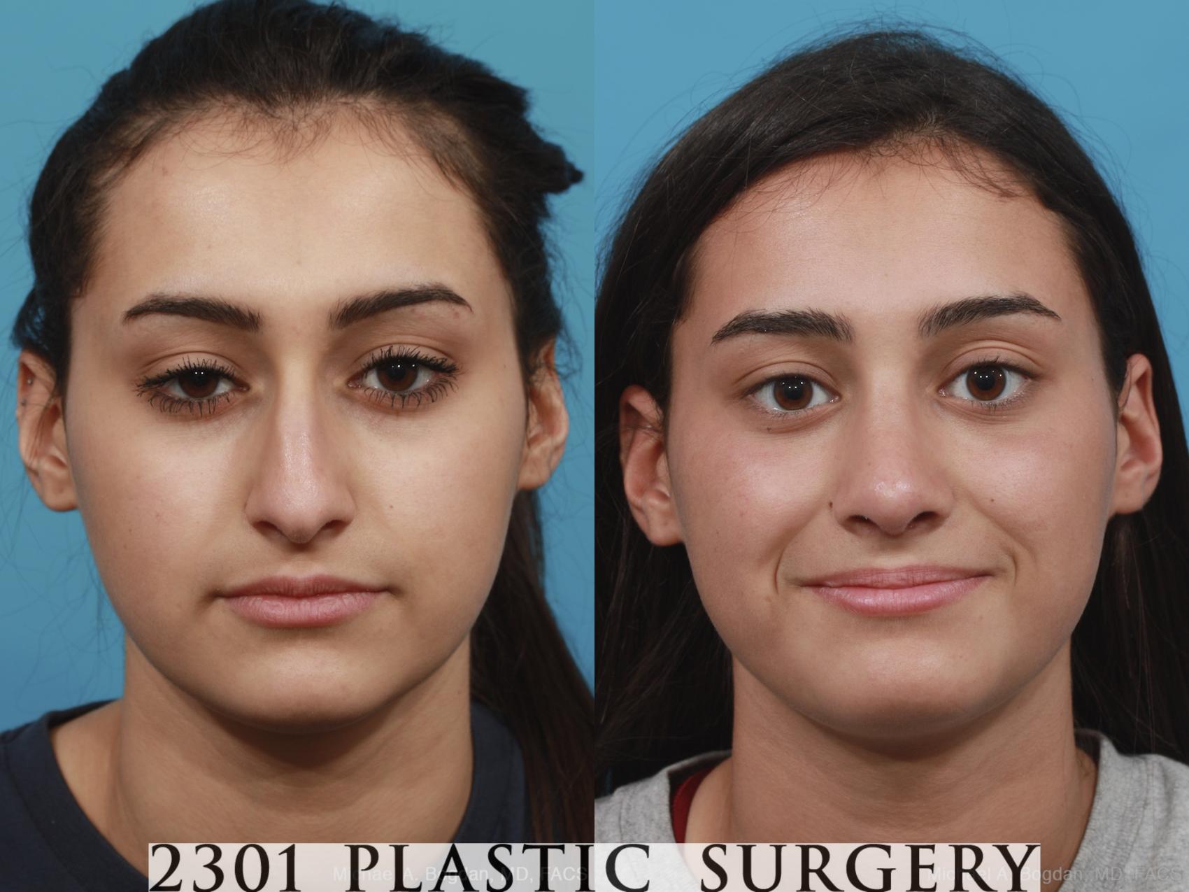 Before & After Rhinoplasty Case 408 View #1 View in Fort Worth, Plano, & Frisco, Texas
