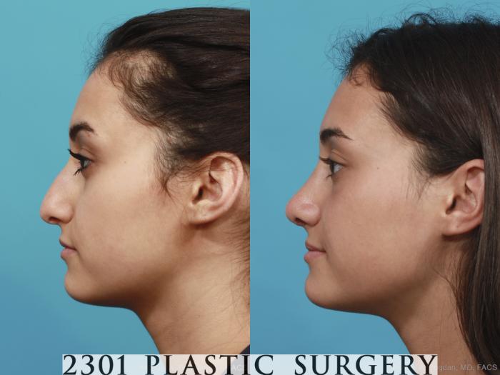 Before & After Rhinoplasty Case 408 View #2 View in Fort Worth, Plano, & Frisco, Texas