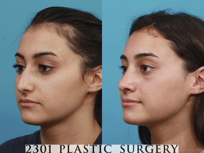 Before & After Rhinoplasty Case 408 View #3 View in Fort Worth, Plano, & Frisco, Texas