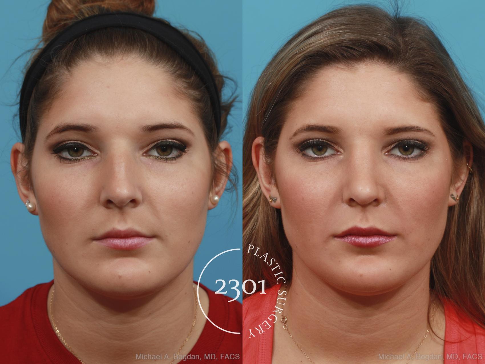 Before & After Rhinoplasty Case 412 View #1 View in Fort Worth, Plano, & Frisco, Texas