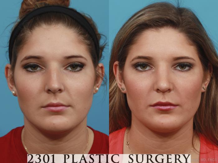 Before & After Rhinoplasty Case 412 View #1 View in Fort Worth, Plano, & Frisco, Texas