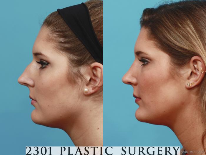Before & After Rhinoplasty Case 412 View #2 View in Fort Worth, Plano, & Frisco, Texas