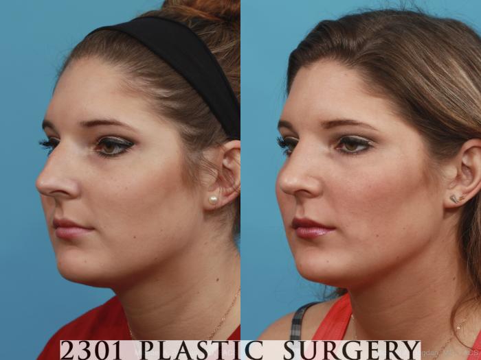 Before & After Rhinoplasty Case 412 View #3 View in Fort Worth, Plano, & Frisco, Texas