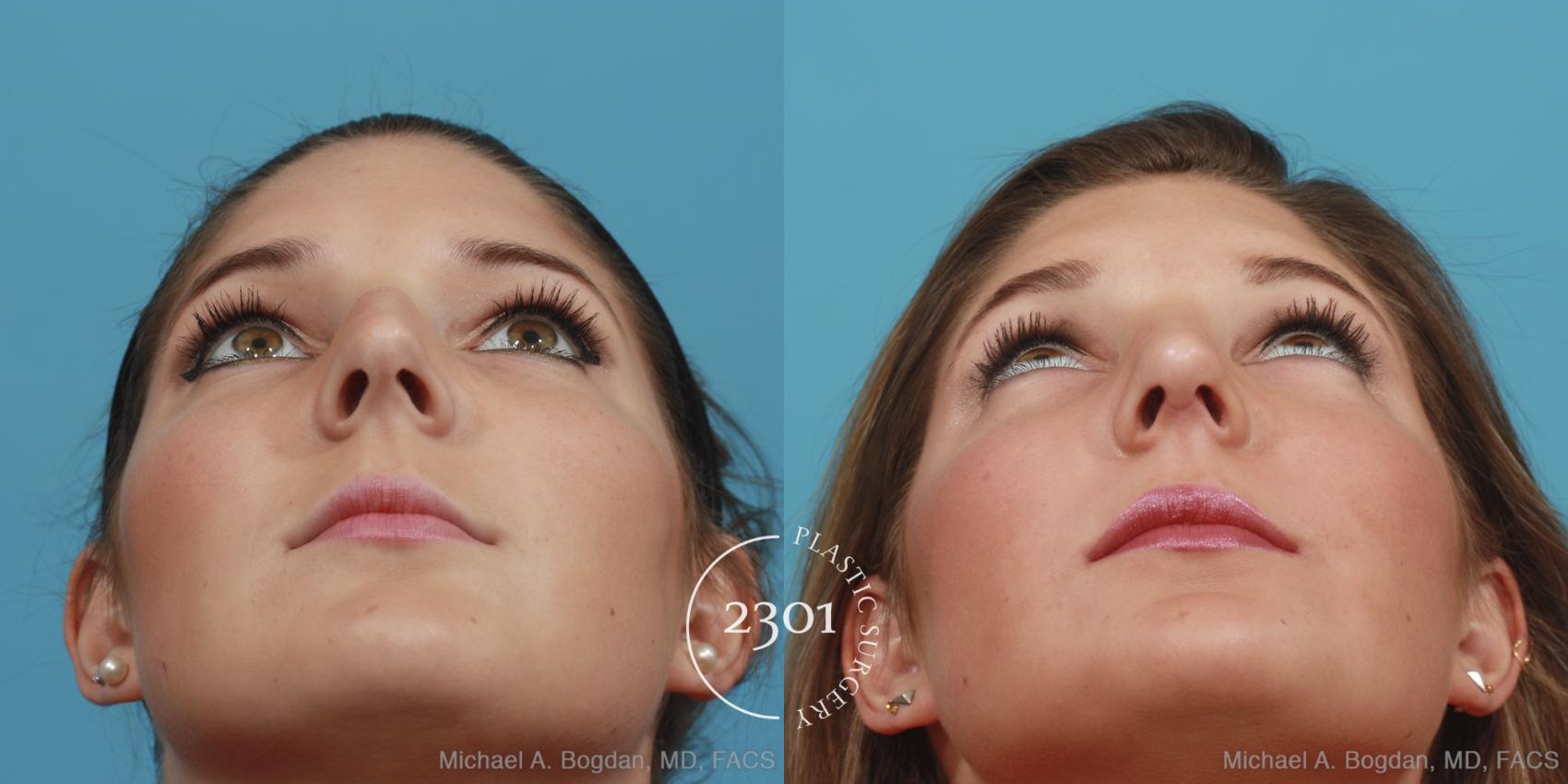 Before & After Rhinoplasty Case 412 View #4 View in Fort Worth, Plano, & Frisco, Texas