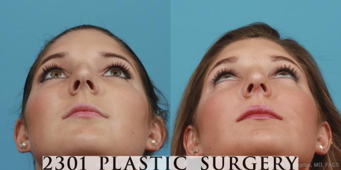 Before & After Rhinoplasty Case 412 View #4 View in Fort Worth, Plano, & Frisco, Texas
