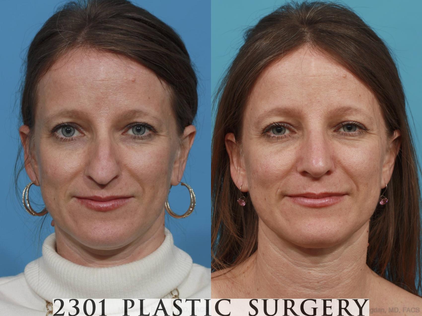 Before & After Rhinoplasty Case 471 View #1 View in Fort Worth, Plano, & Frisco, Texas