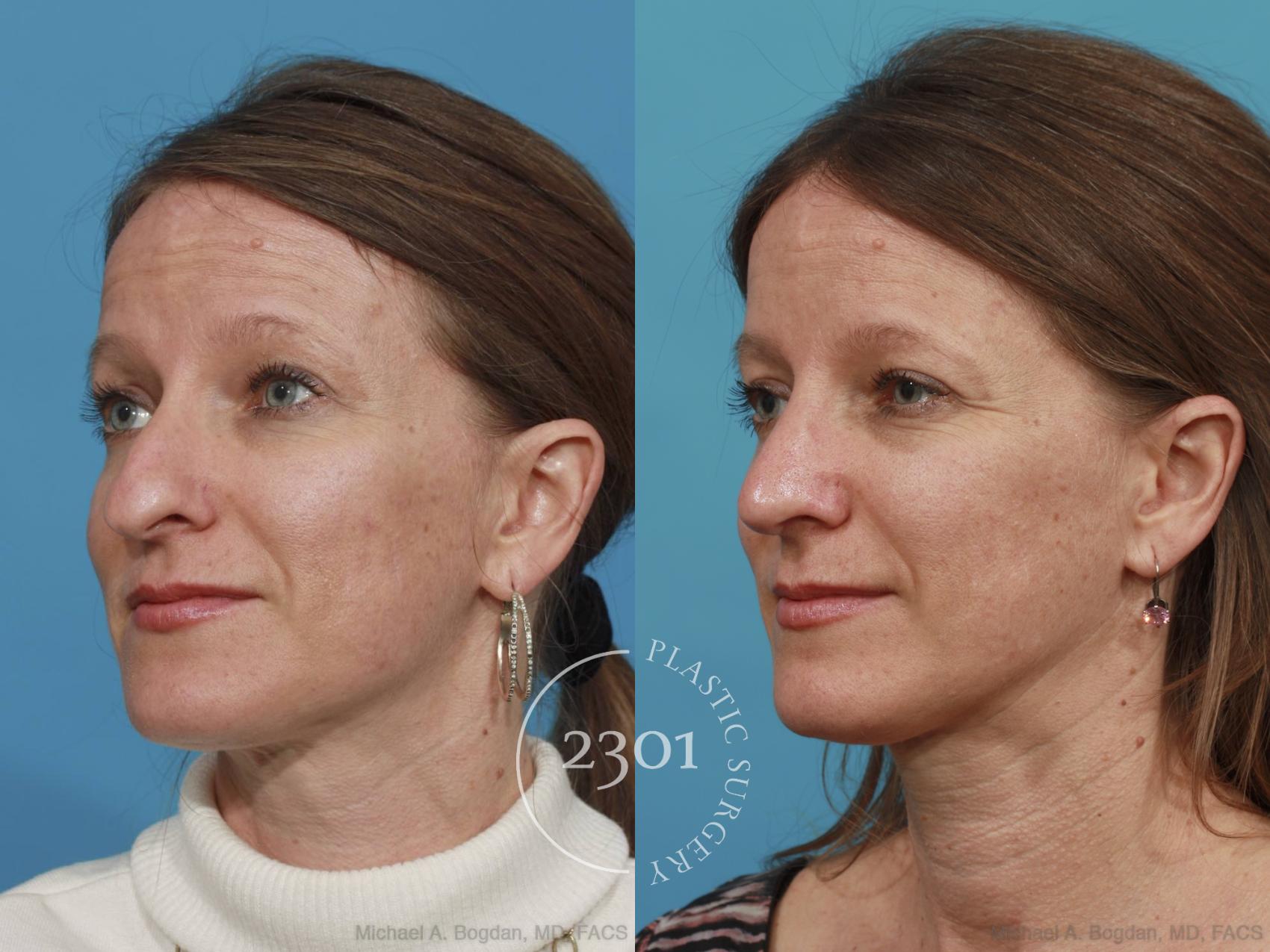 Before & After Rhinoplasty Case 471 View #2 View in Fort Worth, Plano, & Frisco, Texas
