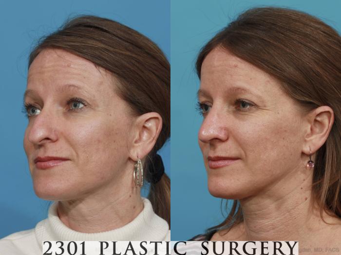 Before & After Rhinoplasty Case 471 View #2 View in Fort Worth, Plano, & Frisco, Texas