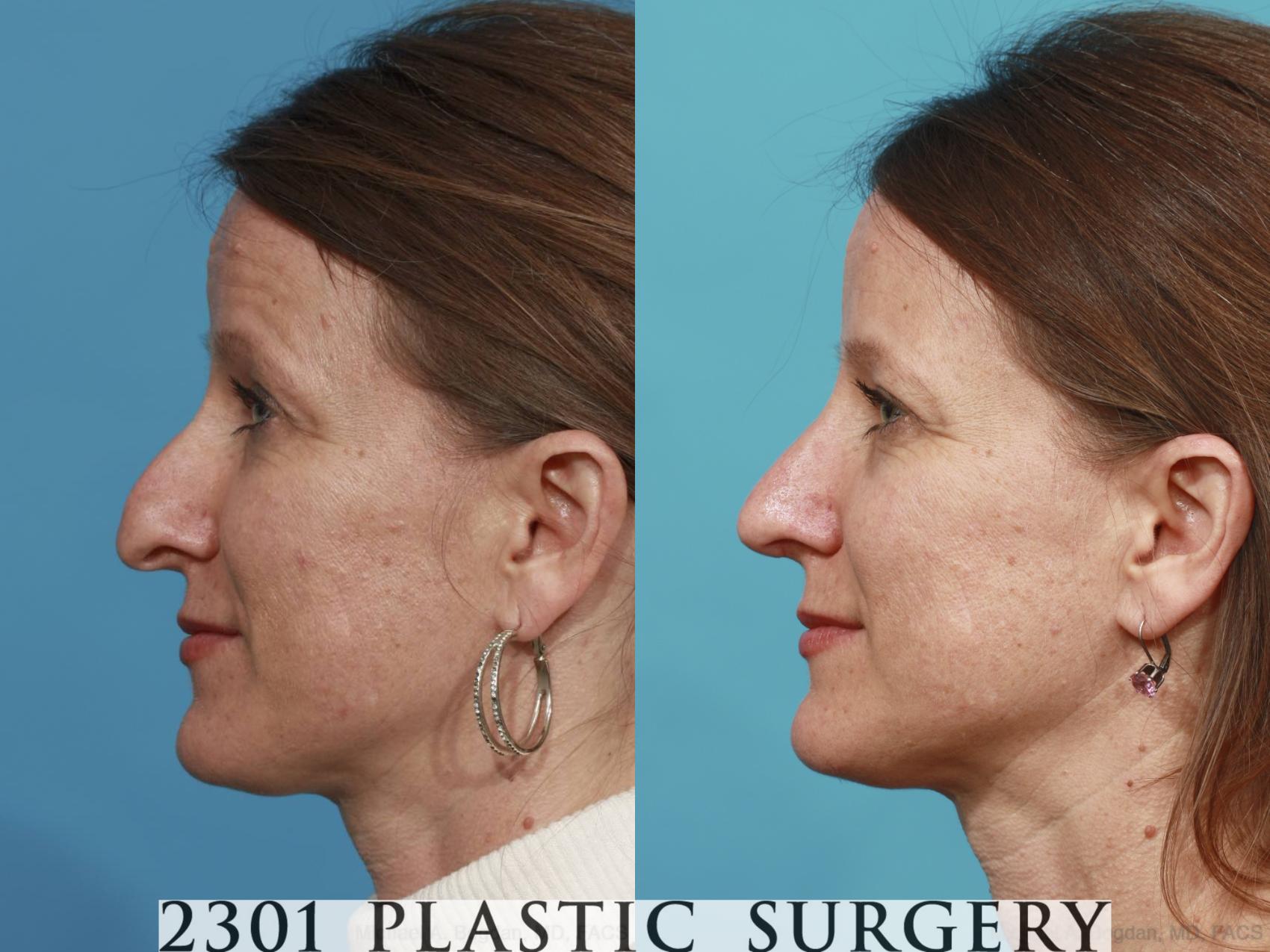 Before & After Rhinoplasty Case 471 View #3 View in Fort Worth & Frisco, Texas