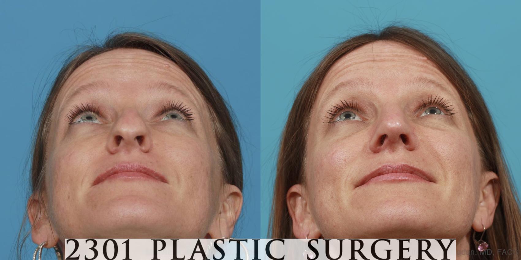 Before & After Rhinoplasty Case 471 View #4 View in Fort Worth & Frisco, Texas