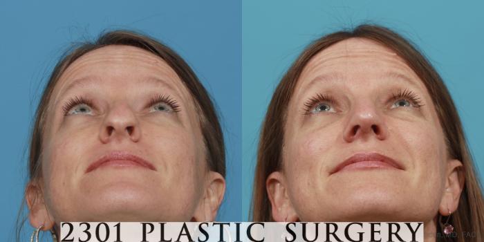 Before & After Rhinoplasty Case 471 View #4 View in Fort Worth, Plano, & Frisco, Texas