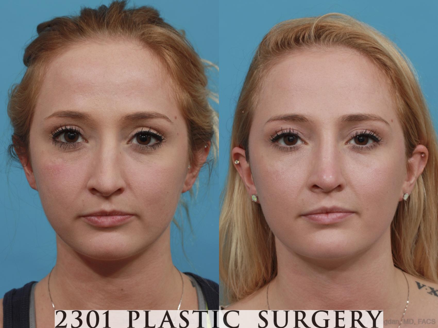 Before & After Rhinoplasty Case 483 View #1 View in Fort Worth, Plano, & Frisco, Texas