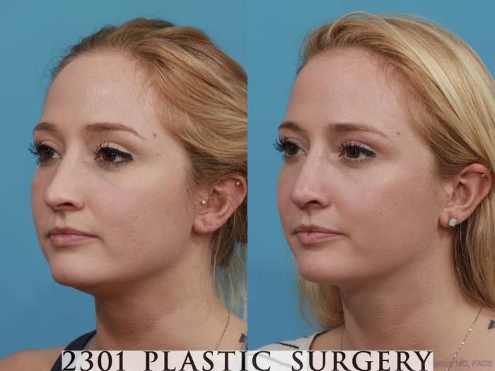Before & After Rhinoplasty Case 483 View #2 View in Fort Worth, Plano, & Frisco, Texas