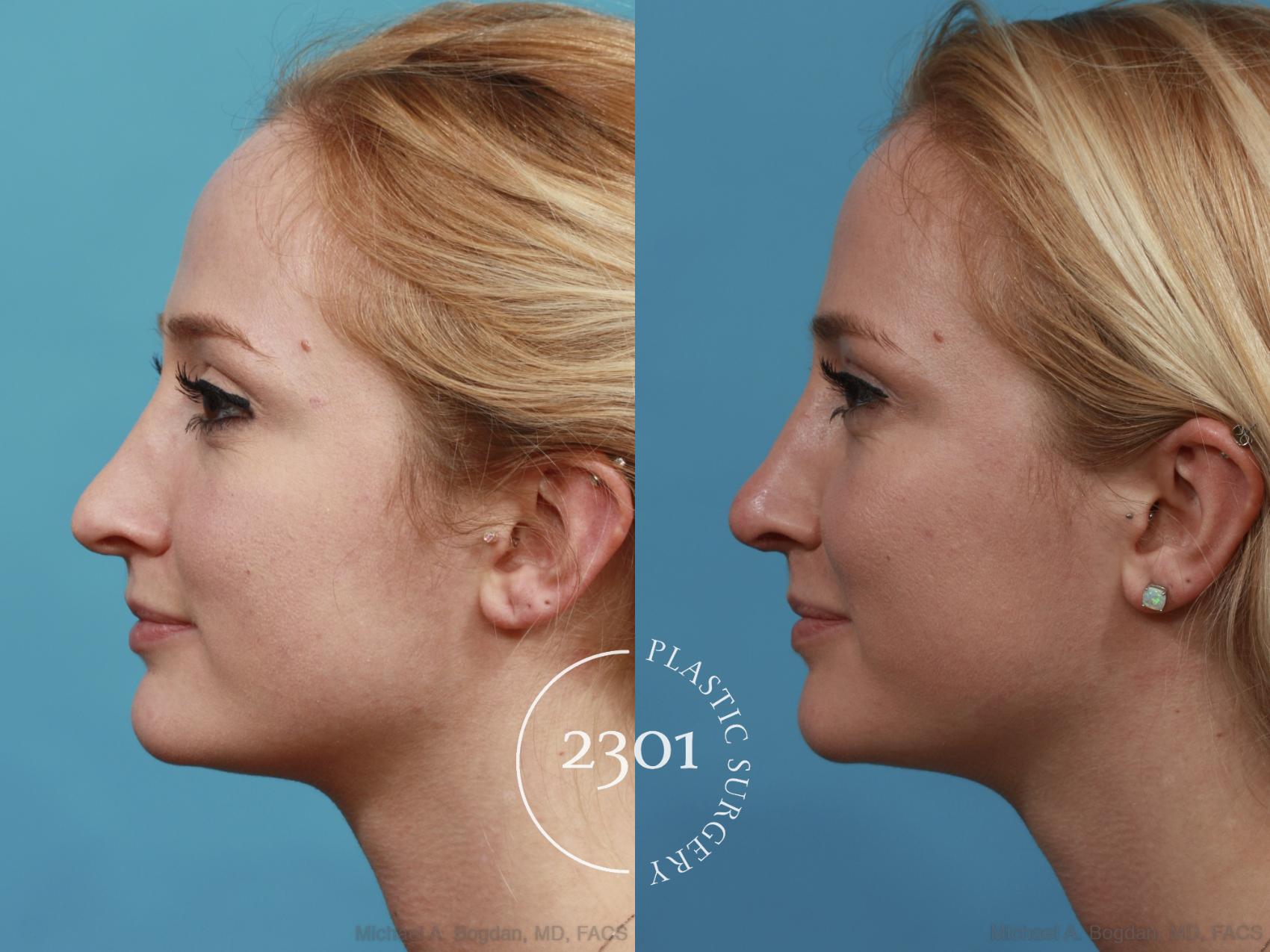 Before & After Rhinoplasty Case 483 View #3 View in Fort Worth, Plano, & Frisco, Texas